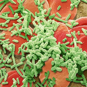 Sepsis. Composite coloured scanning electron micrograph (SEM). Bacteria amongst the red blood cells from the circulatory system. When a strain of harmful bacteria gets into the bloodstream, the resulting infection is called bacterial sepsis, or bacteraemia (commonly known as blood poisoning). Multiplication of the harmful bacteria in the blood stream can cause death. When there is a high amount of toxins produced by bacteria in the blood, a septic shock may occur. Septic shock is a highly dangerous condition in which body tissues are damaged. This kind of infection can be serious, but it can usually be successfully treated with antibiotics, if caught early.
Magnification: X5000 when printed at 10cm wide. (Steve Gschmeissner/ Science Photo Library)