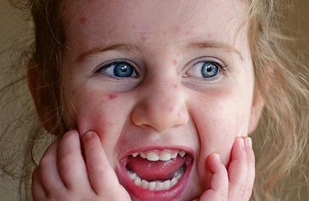 Why do we itch?