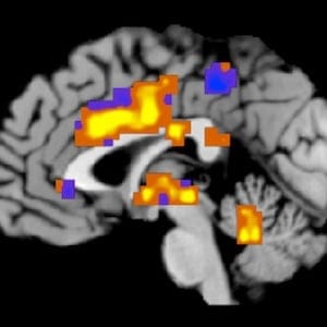 This image created by Tor Wager of the University of Colorado, Boulder showsÜregions of the "neurologic pain signature," a standard map that can be applied to individual people who may be experiencing pain. The map was developed based on heat pain applied to a group of participants' forearms. Activity in yellow-colored areas is predictive of higher levels of pain, and activity in blue-colored areas is predictive of lower levels of pain. In a provocative new study, scientists reported Wednesday, April 10, 2013 that they were able to "see" pain on brain scans and, for the first time, measure its intensity and tell whether a drug was relieving it. Though the research is in its early stages, it opens the door to a host of possibilities. Scans might be used someday to tell when pain is hurting a baby, someone with dementia or a paralyzed person unable to talk. They might lead to new, less addictive pain medicines. (AP Photo/University of Colorado, Boulder, Tor Wager)
