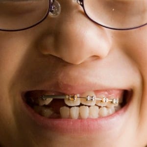 Girl with braces. (Joel Sartore/Getty)